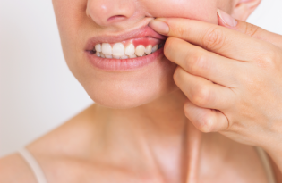 Sangrado al sondaje periodontal y periimplantario en pacientes que reciben terapia de mantenimiento