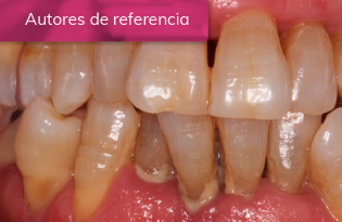 Tratamiento de peri-implantitis y de periodontitis generalizada en estadio III grado C.