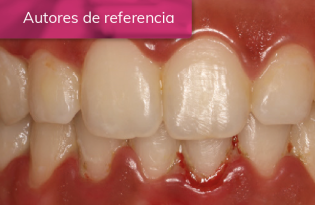 EVOLUCIÓN DE LA CICATRIZACIÓN EN EL TRATAMIENTO DE LA GINGIVITIS NECROSANTE