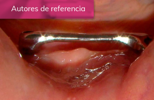 TRATAMIENTO DE PACIENTE CON MUCOSITIS PERIIMPLANTAR Y CELULITIS FACIAL