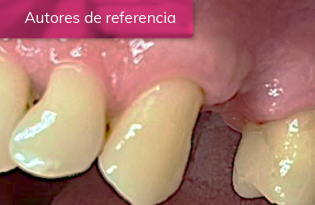 EVOLUCIÓN DE LA CICATRIZACIÓN EN EL TRATAMIENTO DE COLOCACIÓN DE IMPLANTE DENTAL