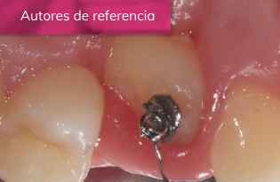 EVOLUCIÓN DE LA CICATRIZACIÓN EN EL TRATAMIENTO QUIRÚRGICO DE COLGAJO DE REPOSICIÓN APICAL PARA EXPOSICIÓN DE CANINO