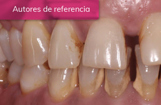 TRATAMIENTO DE PACIENTE CON PERIODONTITIS ESTADIO IV GRADO C