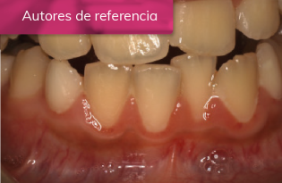EVOLUCIÓN DE LA CICATRIZACIÓN EN EL TRATAMIENTO DE ORTODONCIA CON CIRUGÍA DE CANINO INFERIOR