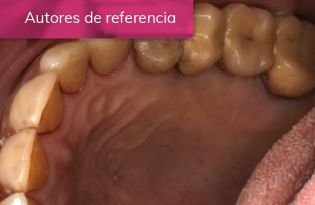 EVOLUCIÓN DE LA CICATRIZACIÓN EN EL TRATAMIENTO DE EXODONCIA