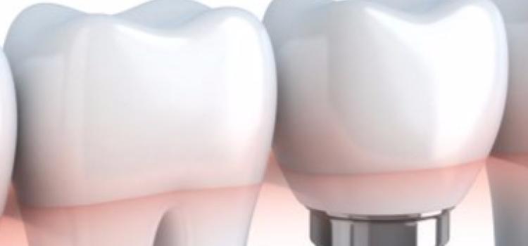 Actualización en el manejo de las patologías periimplantarias