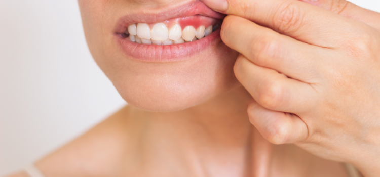 Sangrado al sondaje periodontal y periimplantario en pacientes que reciben terapia de mantenimiento