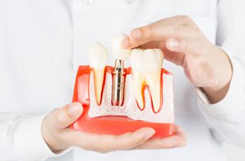 IDRA, una herramienta nueva para prevenir las enfermedades periimplantarias