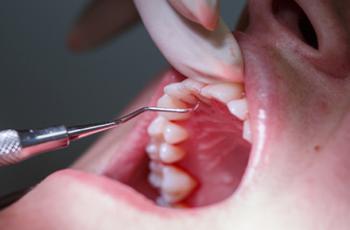 Tratamientos adyuvantes en pacientes con inflamación gingival