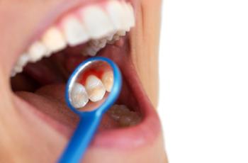 Papel de la inflamación y la genética en la enfermedad periodontal