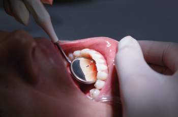 The association between oxidative balance score and periodontitis in...