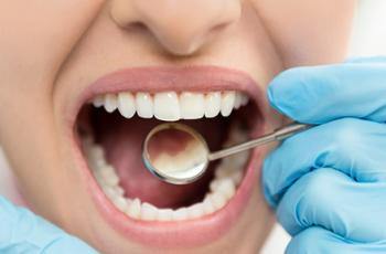 Flapless application of enamel matrix derivative in periodontal retreatment