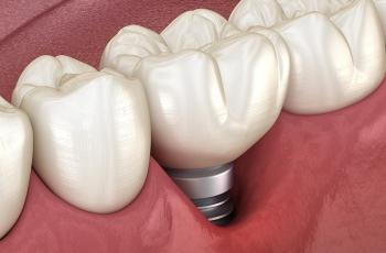 Incidence of Peri-Implantitis and Relationship with Different Conditions:...