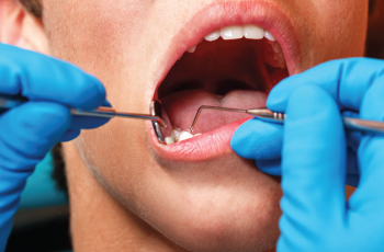 Periodontitis crónica y biomarcadores de estrés oxidativo en saliva y...