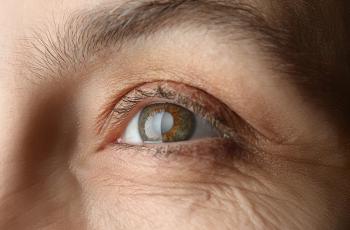 Periodontitis y riesgo de cataratas
