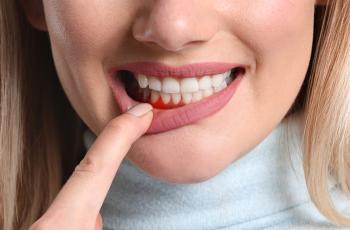 Bolsas periodontales: ¿son reservorios del coronavirus SARS-CoV-2?