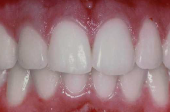 FULL MOUTH REHABILITATION IN COMPOSITE RESIN