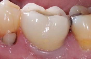 Salud Periimplantaria