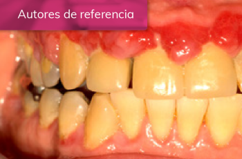 Tratamiento de paciente con periodontitis estadio III : Hiperplasia...