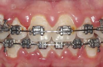 Gingivitis asociada a placa en ortodoncia