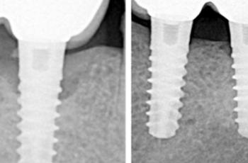 Tratamiento no quirúrgico de la periimplantitis. A propósito de un caso...