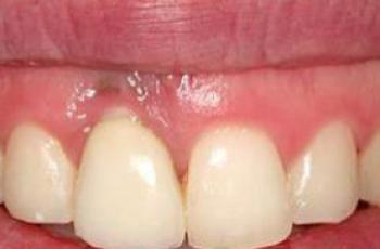 Tratamiento mucogingival en una fenestración en zona estética