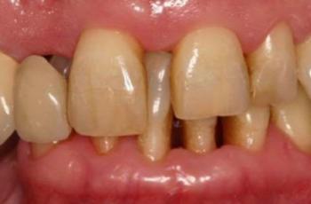 Periodontitis, estadio IV, grado C