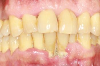 Periodontitis Estadio III, Grado B