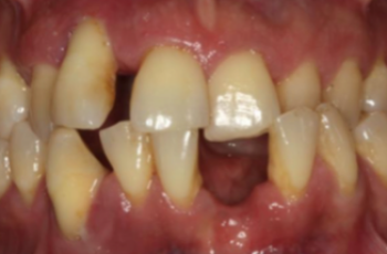 Tratamiento de un diente uniradicular afectado por una lesión...