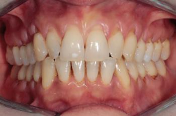 Recesiones múltiples en el maxilar superior en combinación con lesiones...