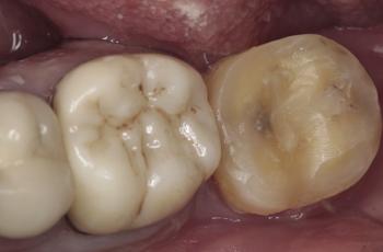 Autotransplante de 3.8 a 3.7: 2 años de seguimiento