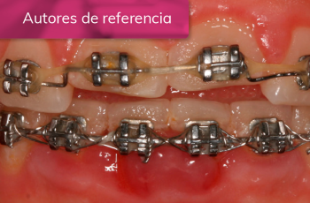 Tratamiento de gingivitis inducida por biofilm dental en un paciente...
