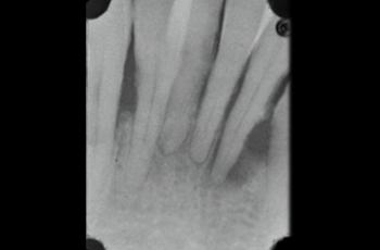 Lesión endo-periodontal