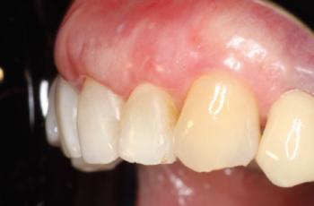 Estética gingival. Reconstrucción lesión cervical no cariosa previo a...