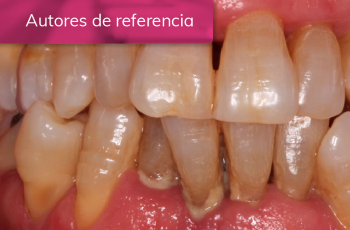 Tratamiento de peri-implantitis y de periodontitis generalizada en estadio...