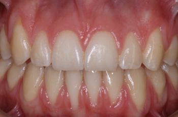 Tratamiento de recesiones RT1 asociadas a hipersensibilidad dentinaria