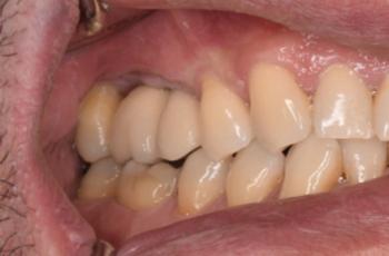 Regeneración ósea tridimensional usando la técnica Khoury