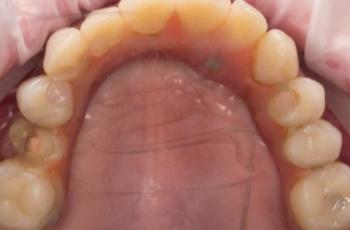 Cubrimiento de recesiones gingivales sobre implantes adyacentes tras...