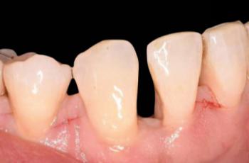 Regeneración periodontal con solo EMD (primer premio)