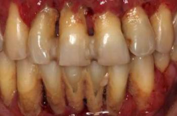 Manifestación oral de Histiocitosis de Células de Langerhans