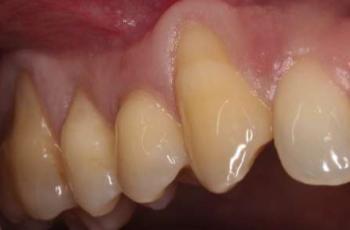 Túnel en asociación con injerto de tejido conectivo autólogo