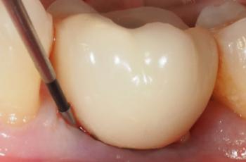 Protocolo de tratamiento no quirúrgico de la periimplantitis
