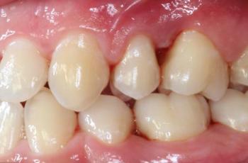 Periodontitis Estadio III Grado C