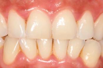 Gingivitis inducida por placa