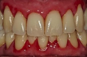 Periodontitis Como Manifestación de Enfermedades Sistémicas