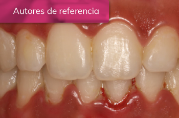 EVOLUCIÓN DE LA CICATRIZACIÓN EN EL TRATAMIENTO DE LA GINGIVITIS...