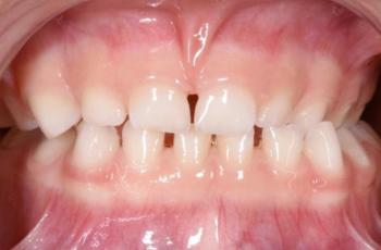 Fibroma oral irritativo con migración patológica de un diente temporal:...