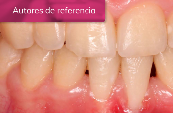 TRATAMIENTO DE GINGIVITIS INDUCIDA POR BIOFILM DENTAL