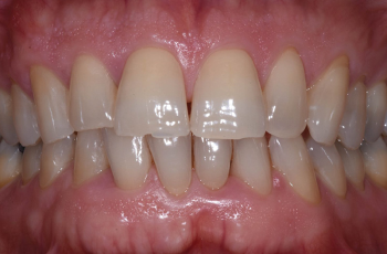 Tratamiento de un defecto intraóseo asociado a hipercementosis