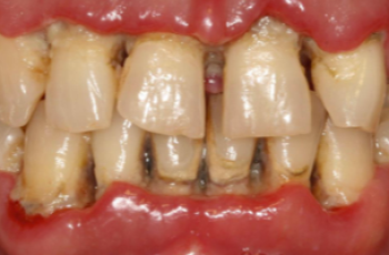 Periodontitis necrosante 